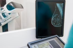 mamogram