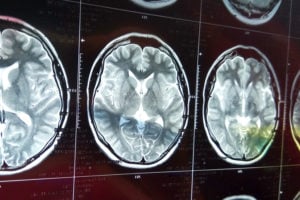 brain MRI