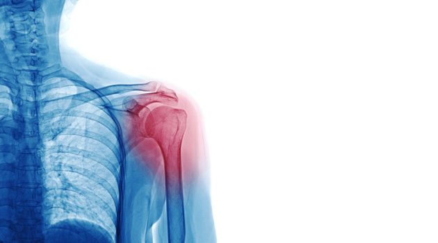 X-ray of shoulder