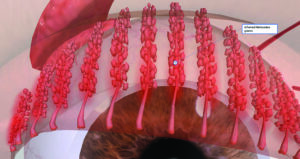 Illustration of inflamed meibomian glands resulting in insufficiently eye lubrication.