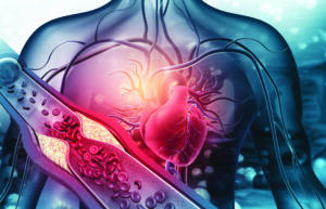 Human heart with blocked arteries. 3d illustration