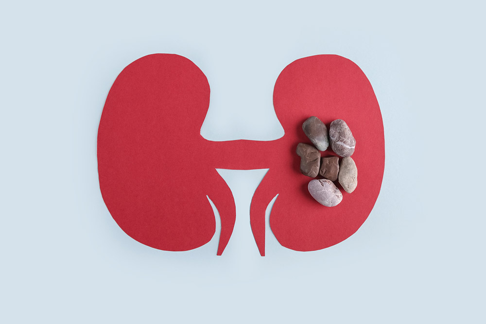 kidney-stone-risk-rises-88-with-this-diet-mistake