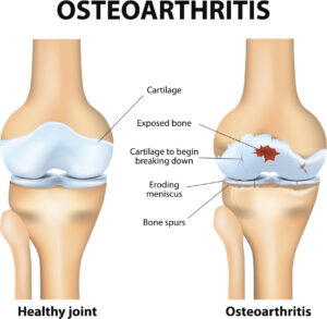 comparison diagram of healthy knee joint versus knee joint with osteoarthritis