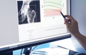 Doctor analyzing bone screening test